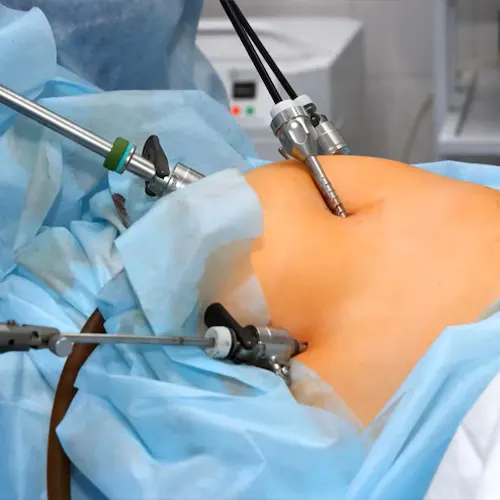 Gynae laparoscopic surgery in Delhi: keyhole instruments during a procedure